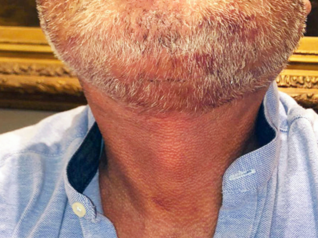 collo-post.jpg Immagine preoperatoria e postoperatoria a 6 mesi. Viene realizzata una correzione intenzionalmente moderata, per non renderla troppo evidente e anacronistica nel contesto del volto della paziente.