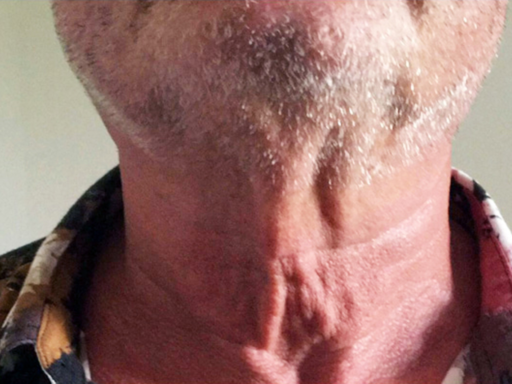 collo-pre.jpg Immagine preoperatoria e postoperatoria a 6 mesi. Viene realizzata una correzione intenzionalmente moderata, per non renderla troppo evidente e anacronistica nel contesto del volto della paziente.