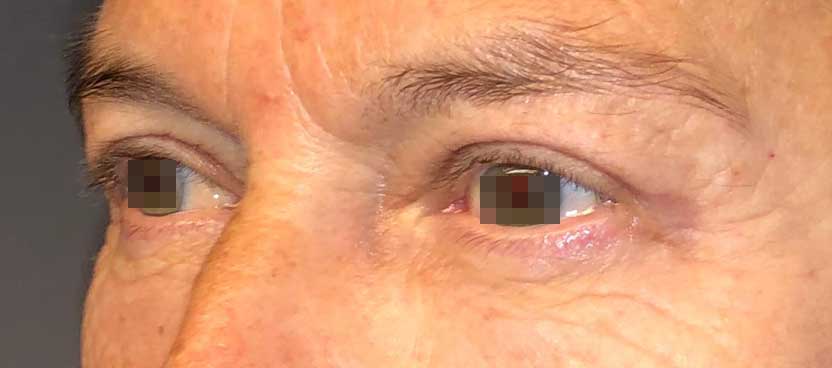 blefaroplastica-post2.jpg Blefaroplastica superiore prima e dopo