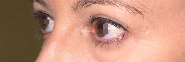 blefarocalasi-post3.jpg Correzione di blefarocalasi (eccesso di cute della palpebra superiore) che condizionava una limitazione della vista nello sguardo verso l'alto: blefaroplastica superiore Prima e dopo