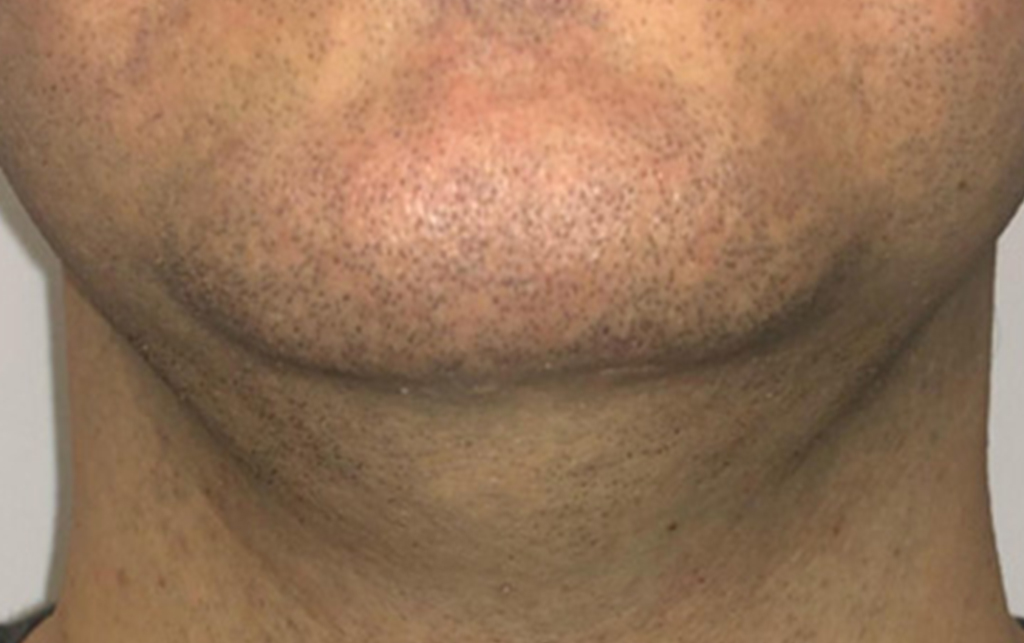mento-pre2.jpg Effetto della liposuzione del mento realizzata in questo paziente in anestesia locale senza nessuna incisione chirurgica. Immagine preparatoria e postoperatoria a 6 mesi