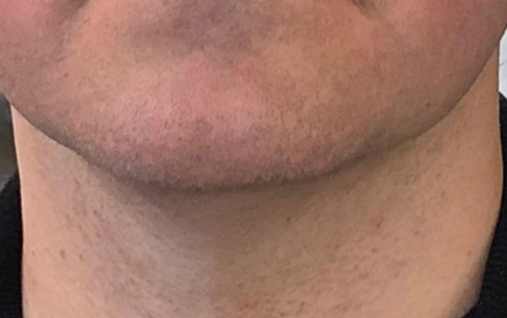 mento-post2.jpg Effetto della liposuzione del mento realizzata in questo paziente in anestesia locale senza nessuna incisione chirurgica. Immagine preparatoria e postoperatoria a 6 mesi