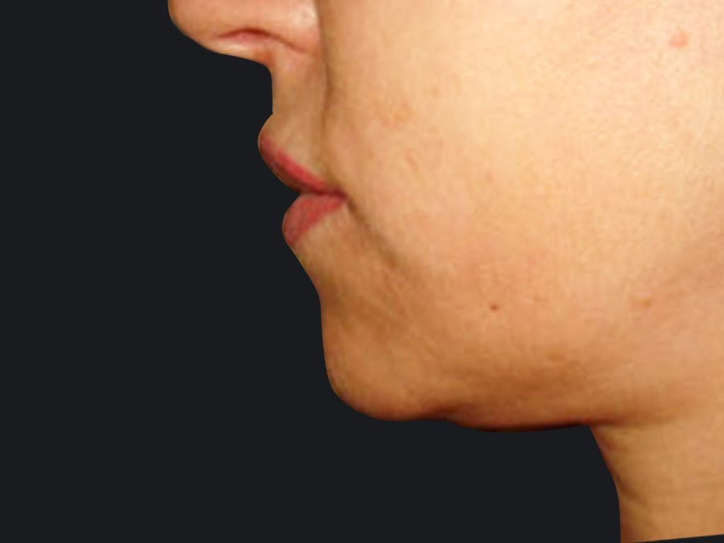 liposuzione-mento-prima.jpg Effetto della liposuzione del mento realizzata in questa paziente in anestesia locale senza nessuna incisione chirurgica. Immagine preparatoria e postoperatoria a 6 mesi