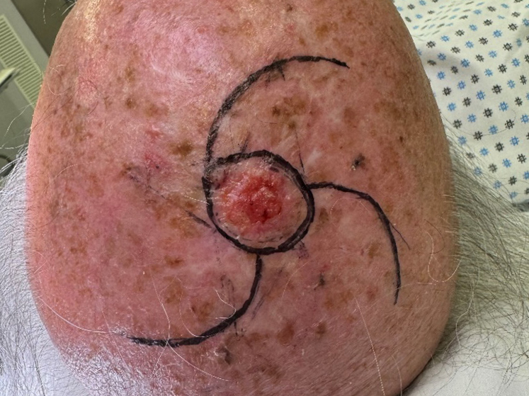 p-14 -Lembi-di-rotazione-pinwheel-flap1.jpg Lembi di rotazione pinwheel flap - carcinoma basocellure del cuoio capelluto e risultato clinico a distanza di 6 mesi