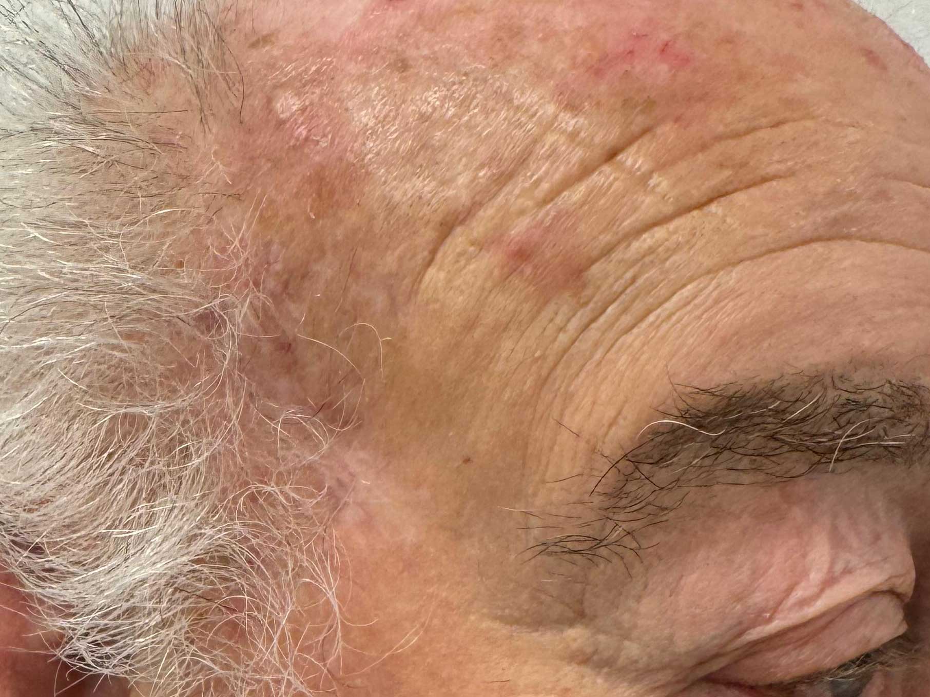 tempia-post.jpg Basalioma della tempia destra - Risultato clinico a distanza di 6 mesi