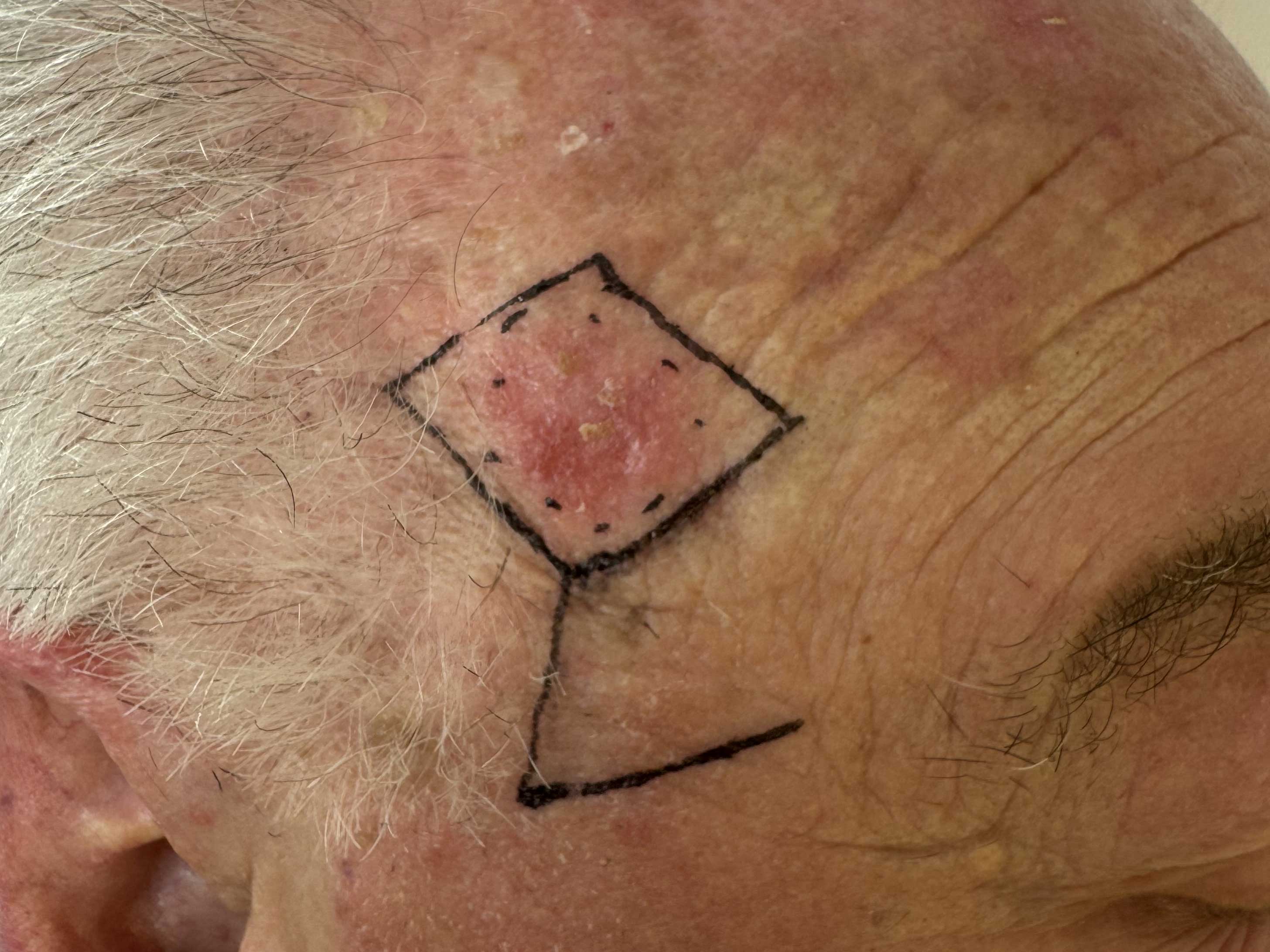 tempia-pre.jpg Basalioma della tempia destra - Risultato clinico a distanza di 6 mesi
