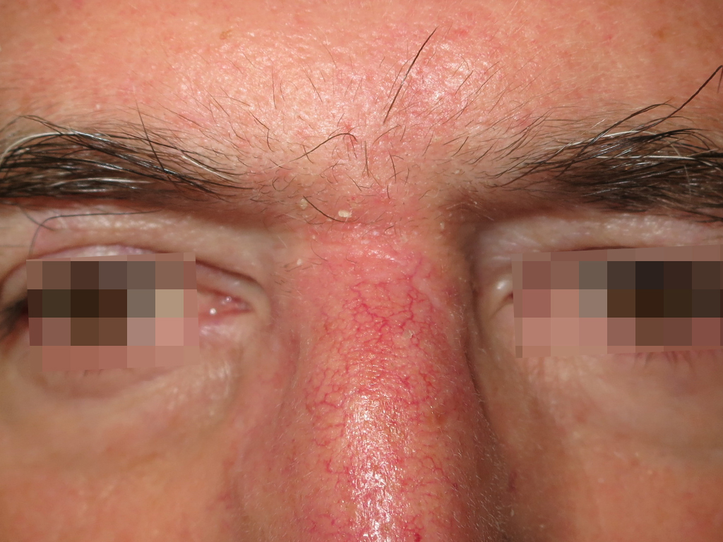 Basalioma del canto interno dell'occhio destro immagine post.jpg Basalioma del canto interno dell'occhio destro immagine pre e post operatoria a 6 mesi