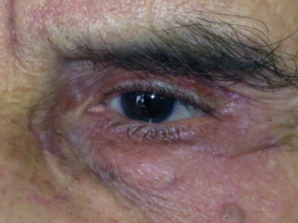 Basalioma-della-palpebra-inferiore-POST.jpg Basalioma della palpebra inferiore -Risultato clinico a distanza di 6 mesi