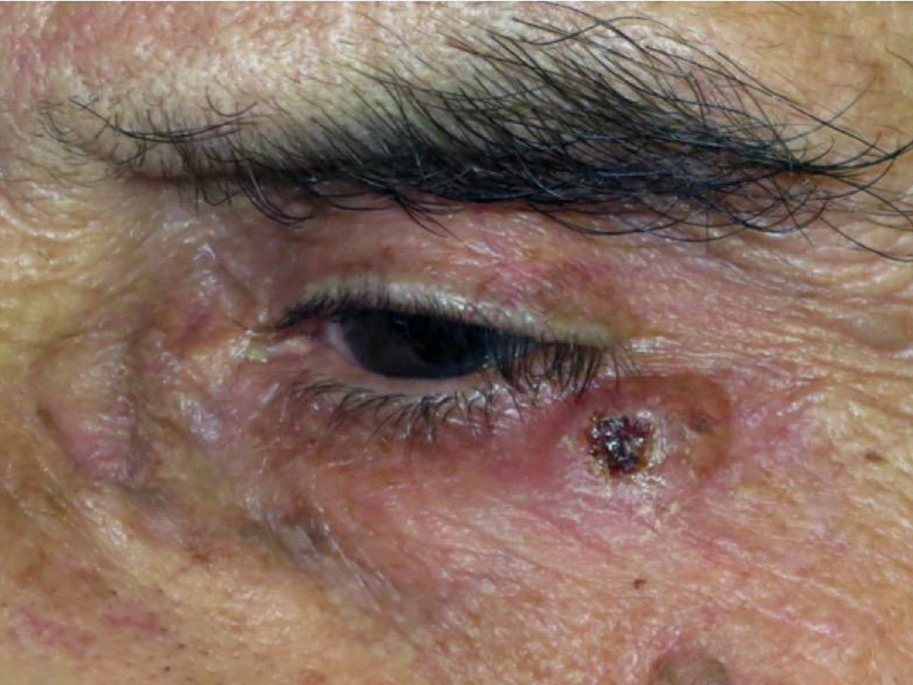 Basalioma-della-palpebra-inferiore-PRE.jpg Basalioma della palpebra inferiore -Risultato clinico a distanza di 6 mesi