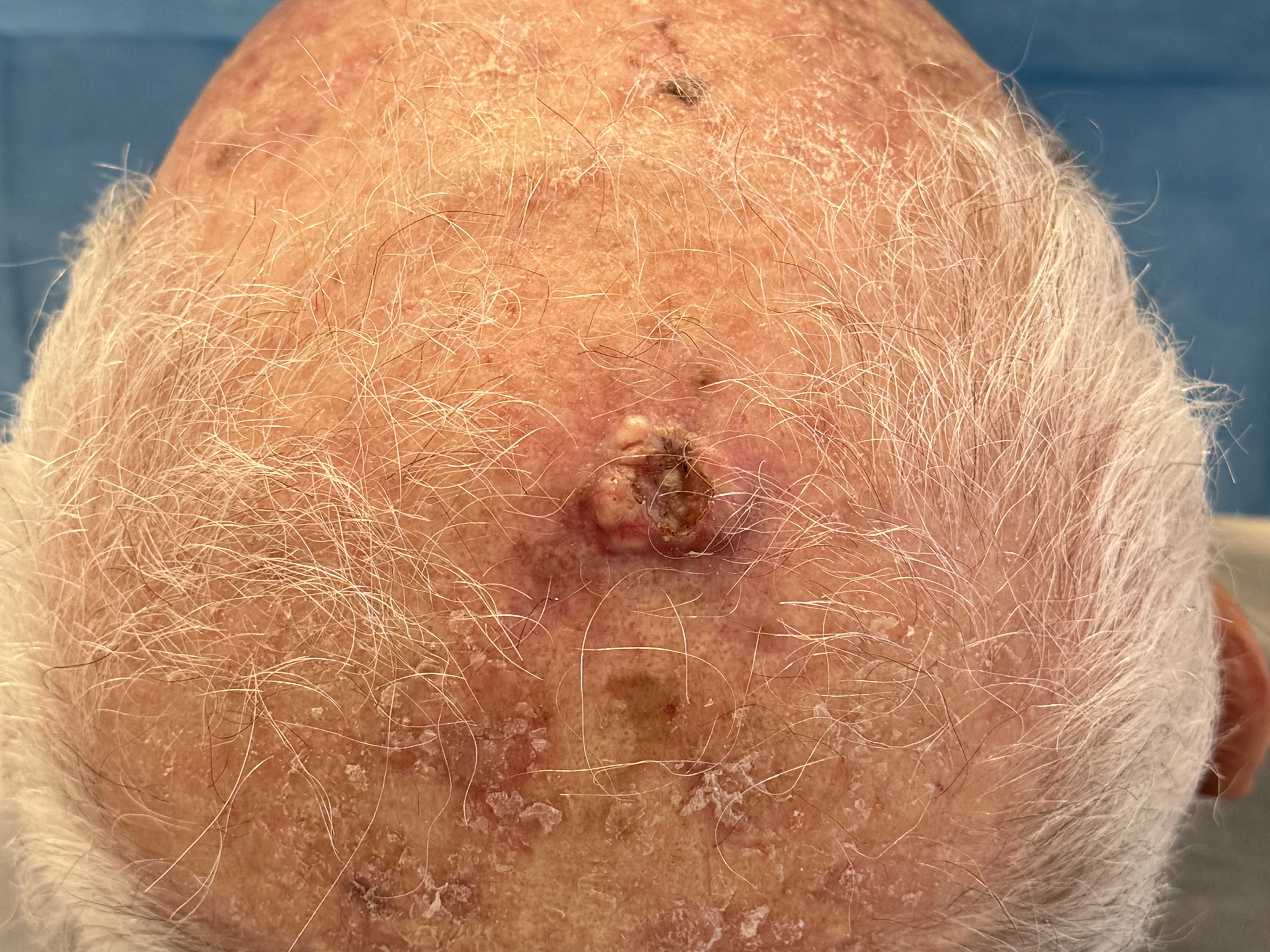 cuoio-capelluto-pre.jpg Basalioma del cuoio capelluto - Risultato clinico a distanza di 6 mesi
