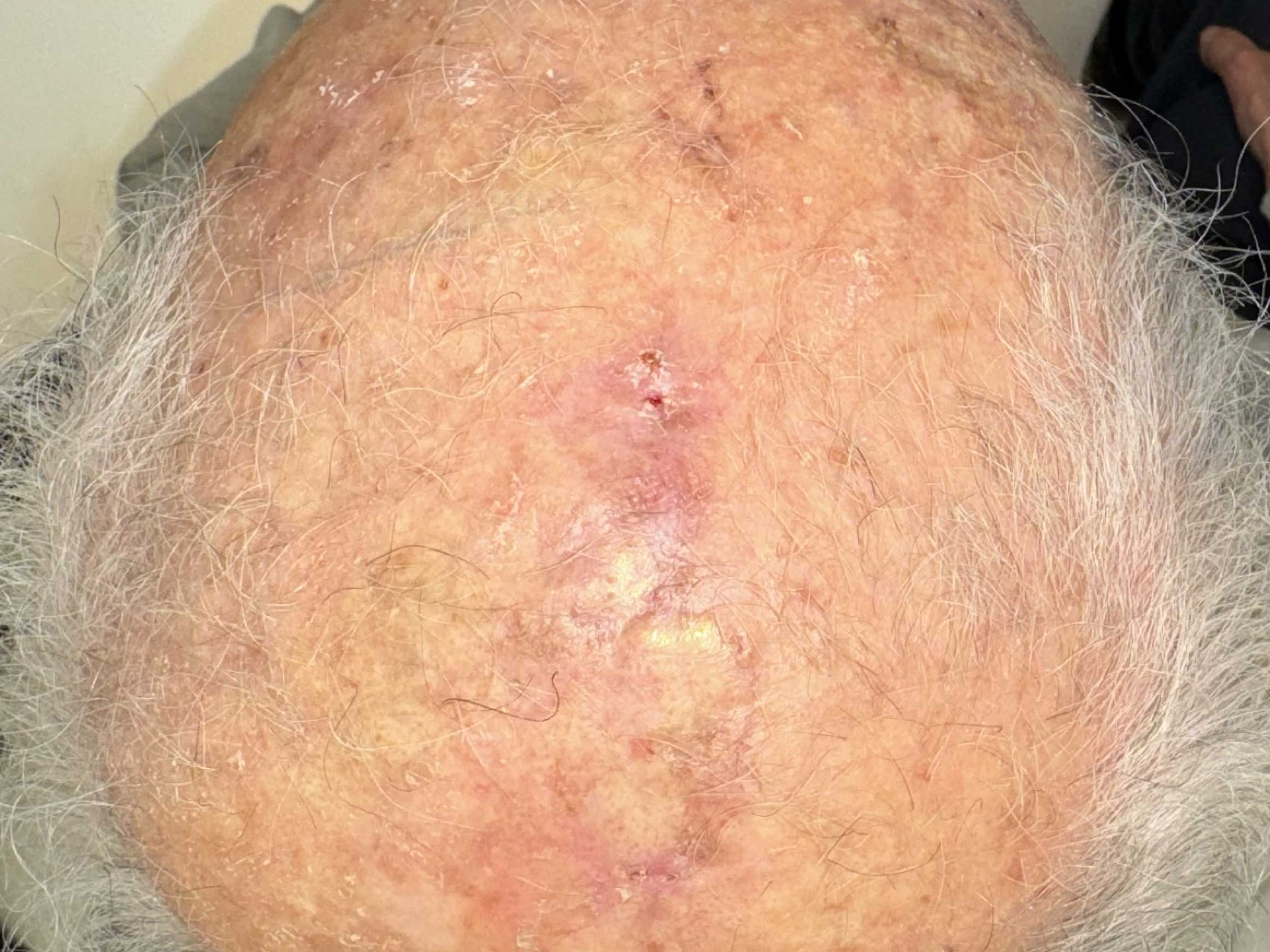 cuoio-capelluto-post.jpg Basalioma del cuoio capelluto - Risultato clinico a distanza di 6 mesi