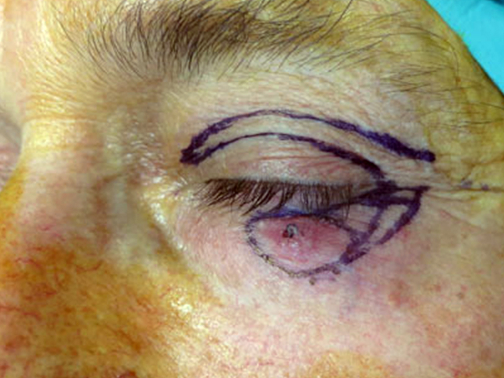 carcinomaPRE.jpg Carcinoma basocellulare infiltrante della palpebra inferiore - Risultato a distanza di 6 mesi che mostra come i segni dell'intervento chirurgico non siano assolutamente riconoscibili