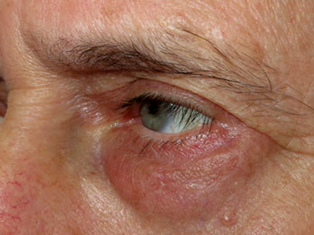 carcinomaPOST.jpg Carcinoma basocellulare infiltrante della palpebra inferiore - Risultato a distanza di 6 mesi che mostra come i segni dell'intervento chirurgico non siano assolutamente riconoscibili