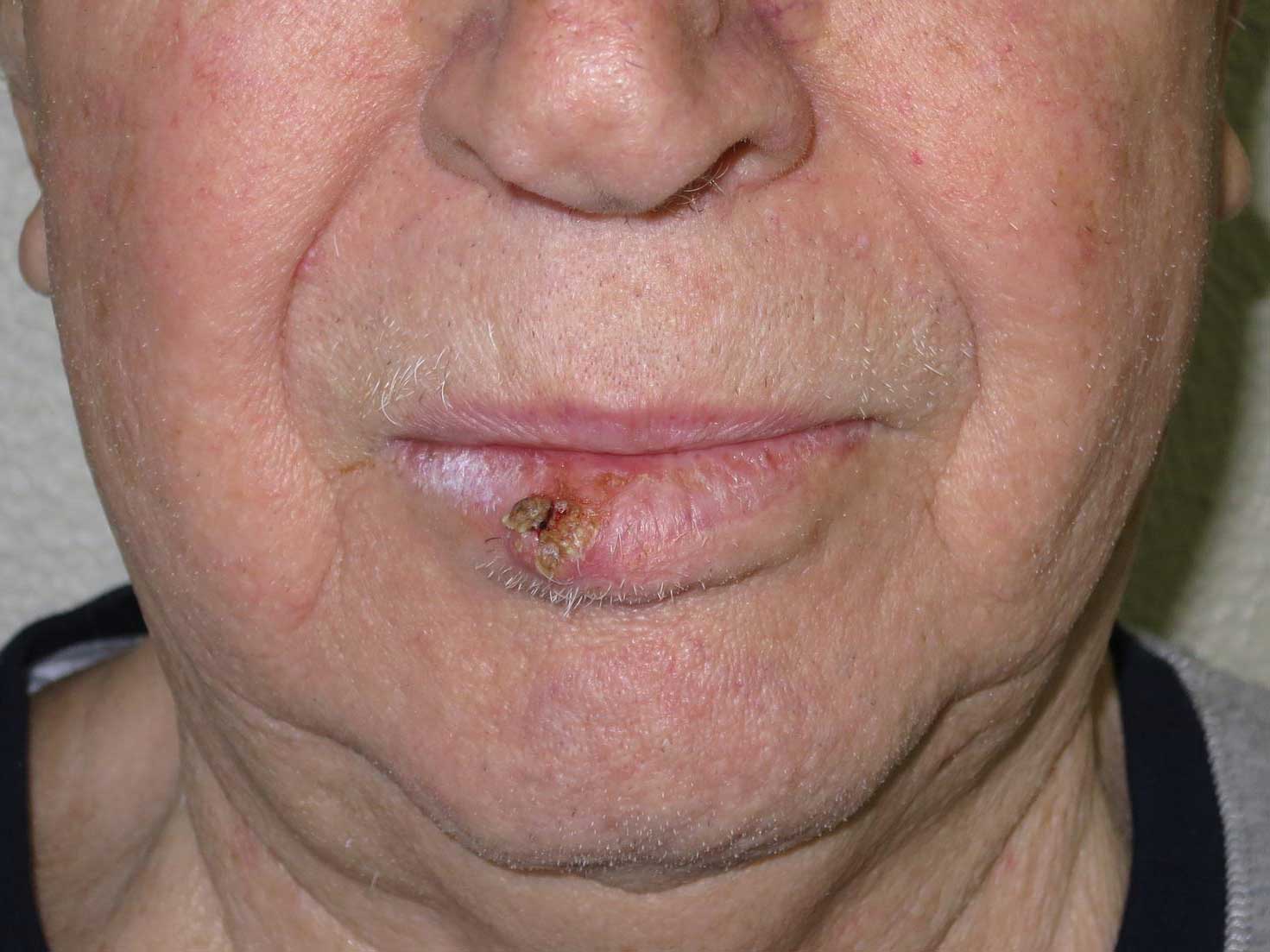 carcinoma-spinocellulare-labbro-inferiore-pre.jpg Carcinoma spinocellulare del labbro inferiore - Risultato clinico a distanza di 6 mesi