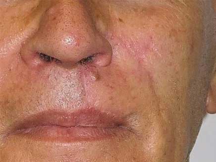 carcinoma-spinocellulare-post.jpg Carcinoma spinocellulare del labbro superiore - Risultato clinico a distanza di 6 mesi