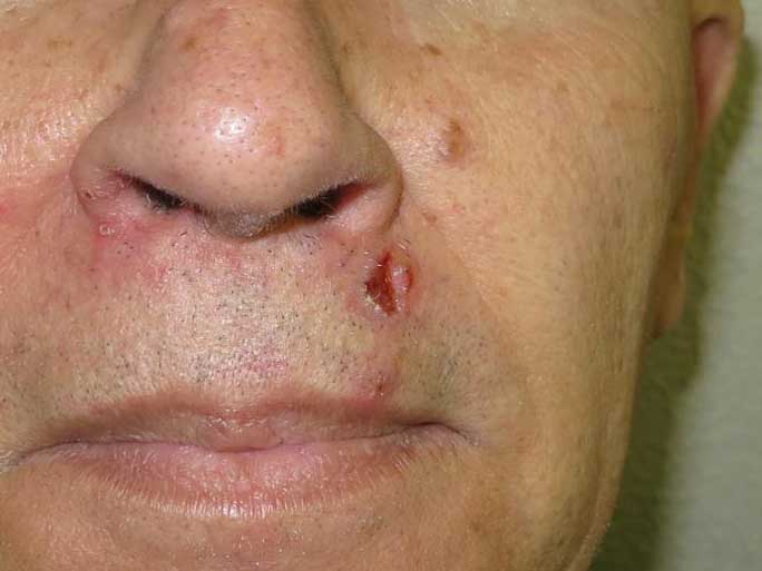 carcinoma-spinocellulare-pre.jpg Carcinoma spinocellulare del labbro superiore - Risultato clinico a distanza di 6 mesi