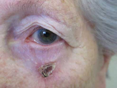 carcinoma-spinocellulare-palpebra-inferiore-pre.jpg Caso di un carcinoma spinocellulare della palpebra inferiore - Immagine postoperatoria che mostra la buona ricostruzione. 