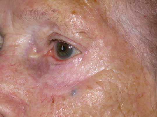 carcinoma-spinocellulare-palpebra-inferiore-post2.jpg Caso di un carcinoma spinocellulare della palpebra inferiore - Immagine postoperatoria che mostra la buona ricostruzione. 