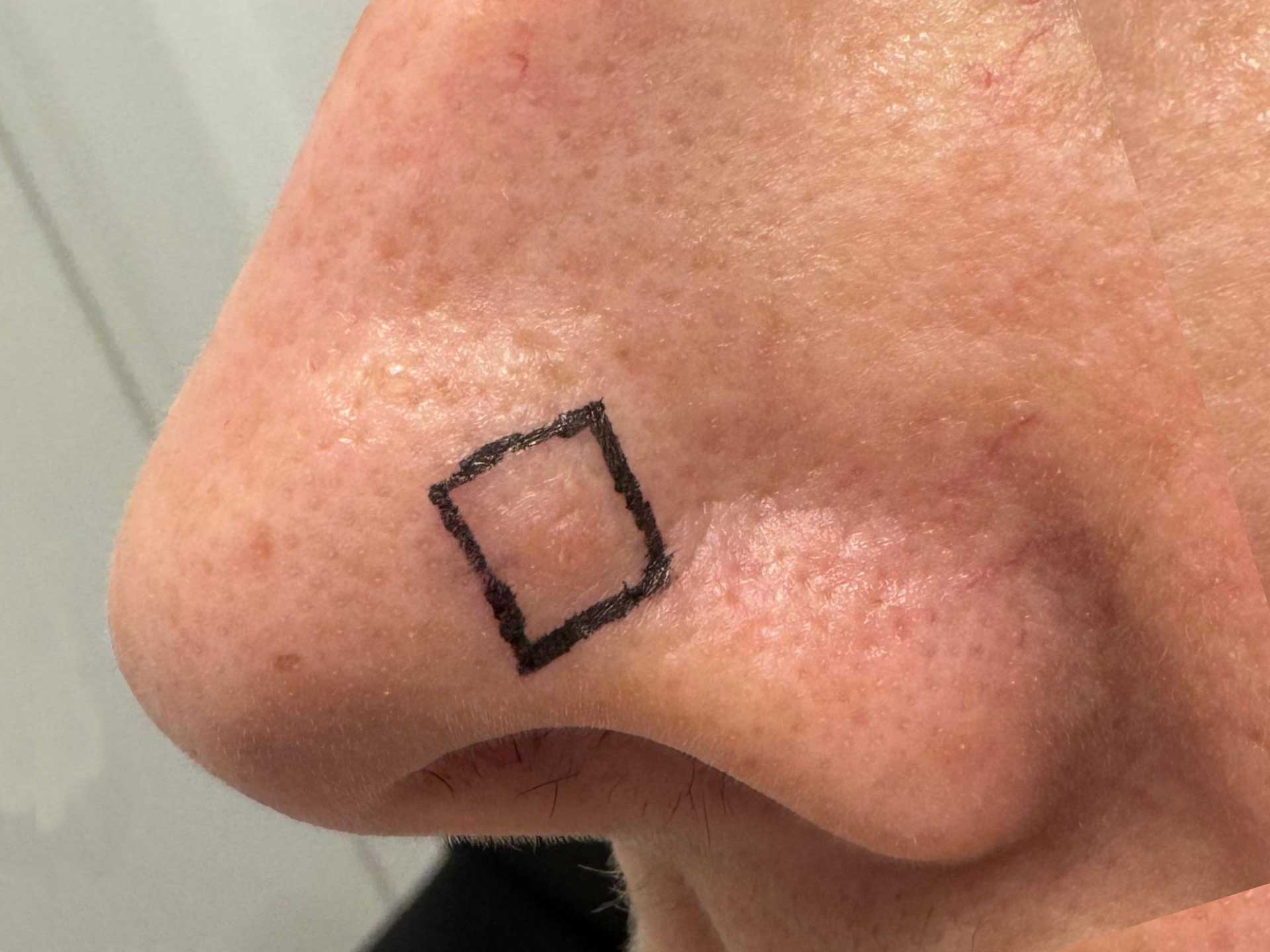 carcinoma-basocellulare-del-naso-pre.jpg Carcinoma basocellulare del naso base pre e post operatoria a 3 mesi
