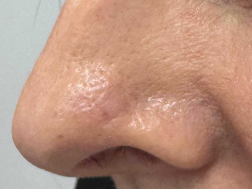 guarigione-a-distanza-di-3-mesi.jpg Carcinoma basocellulare del naso base pre e post operatoria a 3 mesi