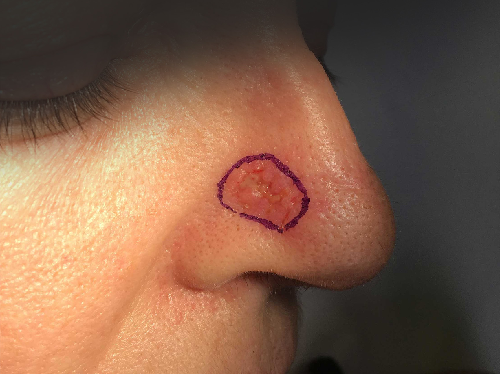 naso pre.jpg Basailioma del ala nasale destra - Risultato clinico a distanza di 6 mesi