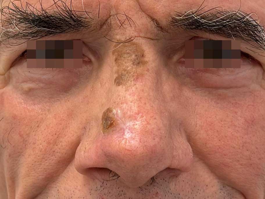 naso-pre2.jpg Basailioma della punta del naso - la cheratosi voluminosa del dorso è benigna ed è stata volutamente conservata - Risultato clinico a distanza di 4 mesi