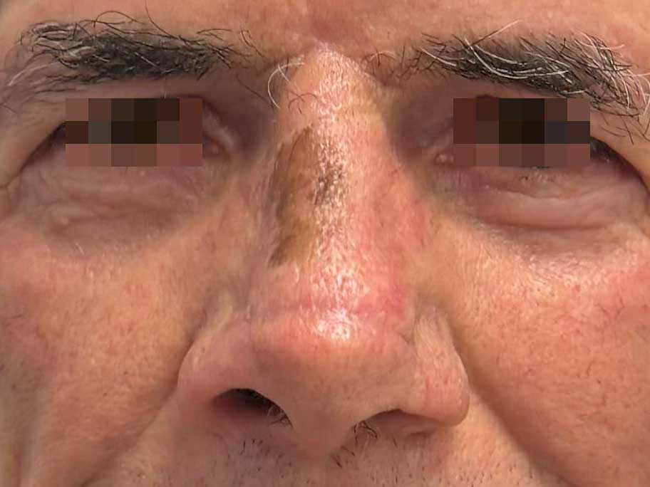 naso-post2.jpg Basailioma della punta del naso - la cheratosi voluminosa del dorso è benigna ed è stata volutamente conservata - Risultato clinico a distanza di 4 mesi