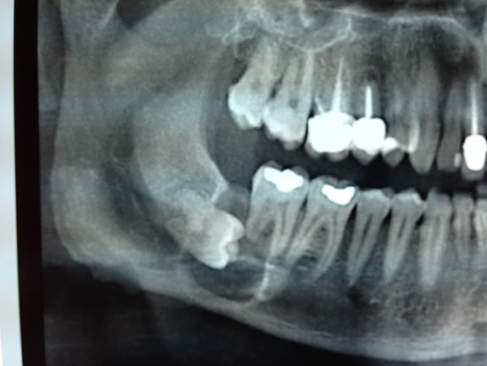 Cisti-follicolare-panoramica-pre.jpg Caso di cisti follicolare con l'elemento 48 - Radiografia pre e postoperatoria a due anni dall'intervento di una cisti follicolare con l'elemento 48 incluso: si osserva la completa rigenerazione ossea locale senza recidive