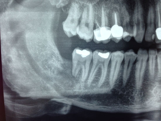 Cisti-follicolare-panoramica-post.jpg Caso di cisti follicolare con l'elemento 48 - Radiografia pre e postoperatoria a due anni dall'intervento di una cisti follicolare con l'elemento 48 incluso: si osserva la completa rigenerazione ossea locale senza recidive