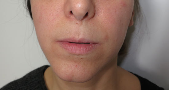 mentoplastica-pre2.jpg Mentoplastica - Mentoplastica di centratura in paziente con laterodeviazione mandibolare non evolutiva - Immagine preoperatoria e postoperatoria ad un anno di distanza