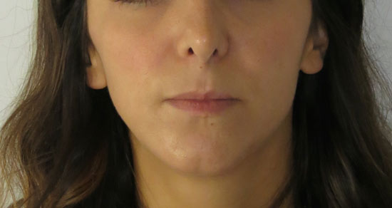 mentoplastica-post2.jpg Mentoplastica - Mentoplastica di centratura in paziente con laterodeviazione mandibolare non evolutiva - Immagine preoperatoria e postoperatoria ad un anno di distanza