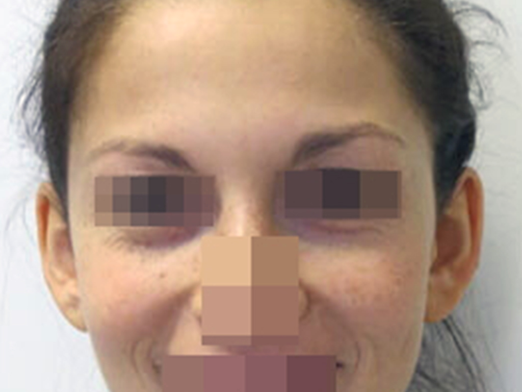 1PRE.jpg Otoplastica per la correzione delle orecchie a ventola Immagine preoperatoria e postoperatoria a 6 mesi dall'intervento fronte