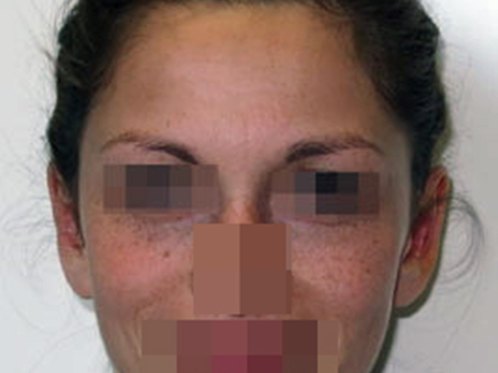PRE.jpg Otoplastica per la correzione delle orecchie a ventola Immagine preoperatoria e postoperatoria a 6 mesi dall'intervento fronte