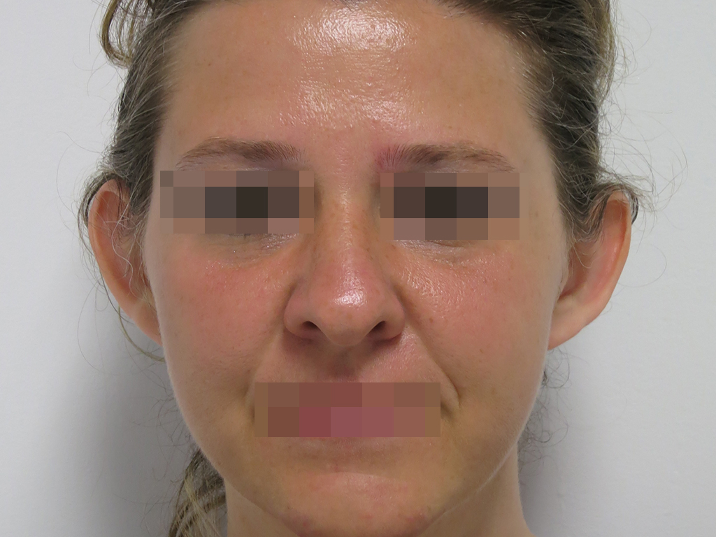 3PRE.jpg Immagine preoperatoria e postoperatoria a 6 mesi dall'intervento