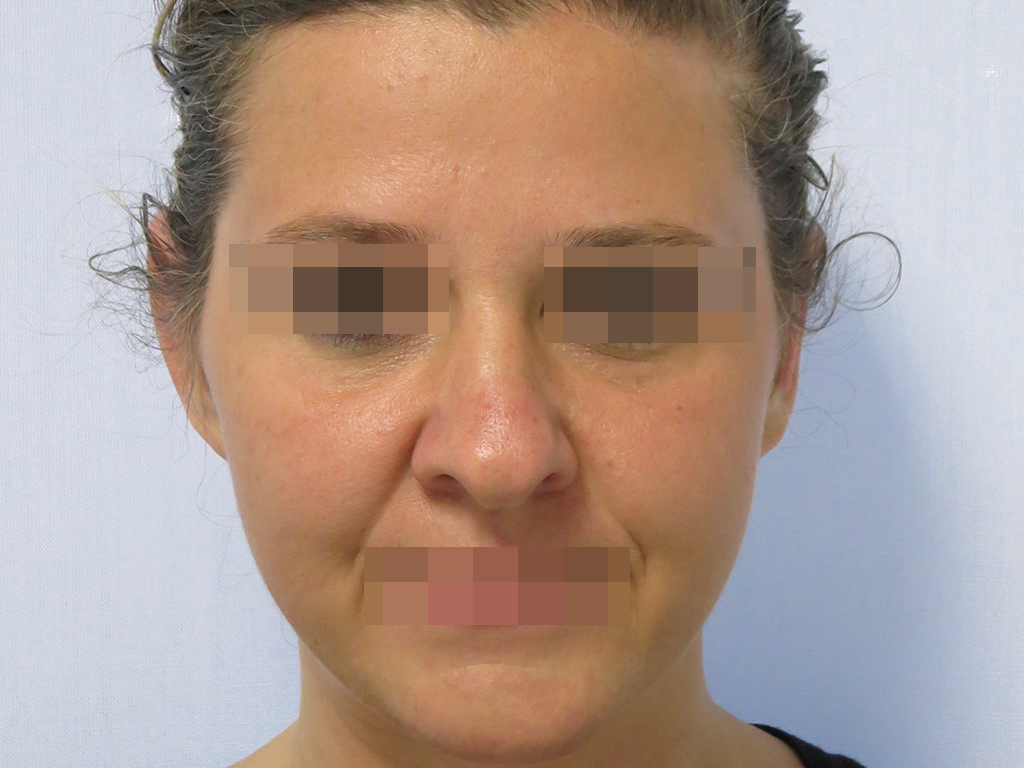 3POST.jpg Immagine preoperatoria e postoperatoria a 6 mesi dall'intervento