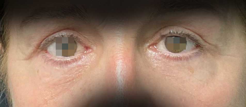 blefaroplastica-post.jpg Blefaroplastica completa , superiore ed inferiore pre e post a 6 mesi