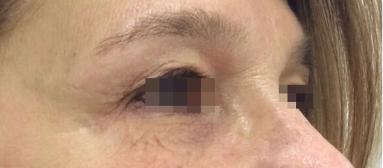 botox-post-lato.jpg BOTOX - tossina botulinica - prima e dopo