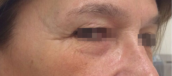 botox-pre-lato2.jpg BOTOX - tossina botulinica - prima e dopo