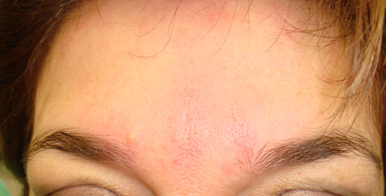 filler-fronte-milano-post.jpg Trattamento di filler a base di acido jaluronico per attenuare le rughe frontali. Foto preoperatoria e subito dopo il trattamento: l'effetto è immediato e si nota l'arrossamento della cute in sede di infiltrazione, che scompare dopo poche ore.
