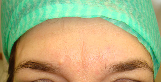 filler-fronte-milano-pre.jpg Trattamento di filler a base di acido jaluronico per attenuare le rughe frontali. Foto preoperatoria e subito dopo il trattamento: l'effetto è immediato e si nota l'arrossamento della cute in sede di infiltrazione, che scompare dopo poche ore.