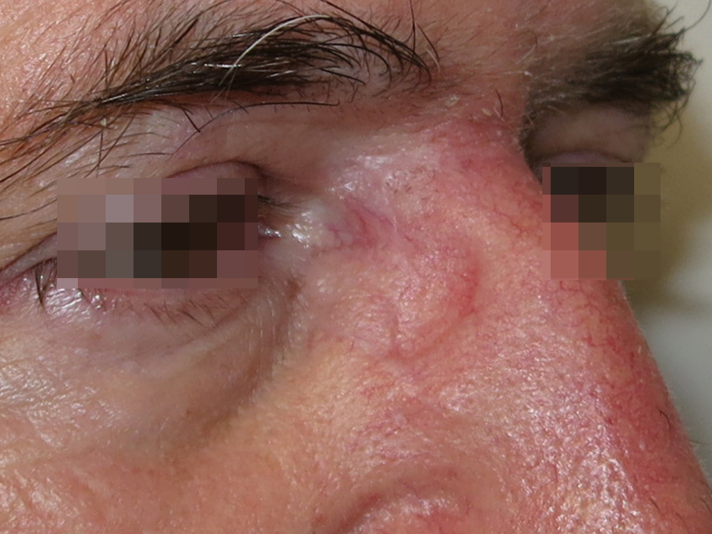 Basalioma del canto interno dell'occhio destro immagine post lato.jpg Basalioma del canto interno dell'occhio destro immagine pre e post operatoria a 6 mesi