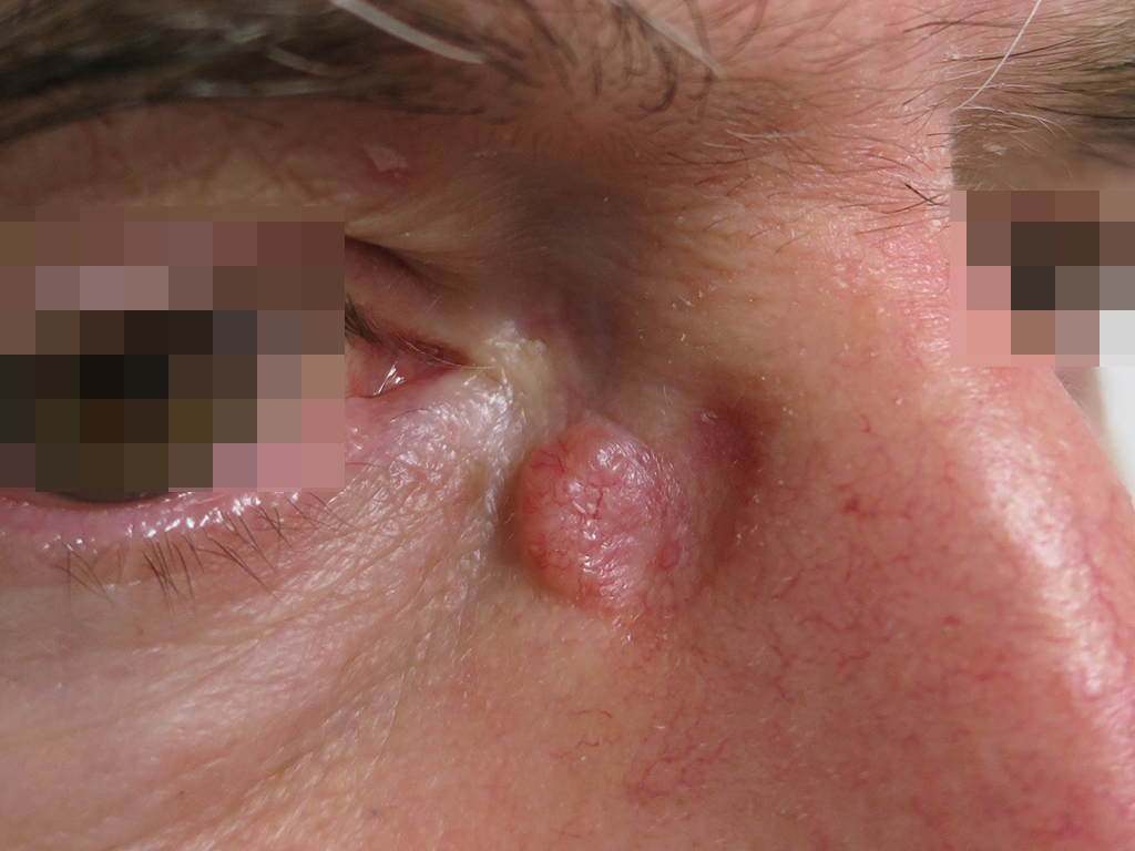 Basalioma del canto interno dell'occhio destro immagine pre lato.jpg Basalioma del canto interno dell'occhio destro immagine pre e post operatoria a 6 mesi