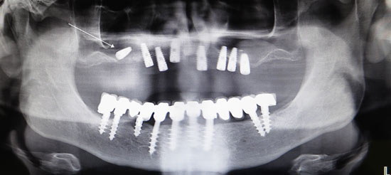 recupero-impianto-dal-seno-mascellare-pre.jpg Recupero di un impianto dislocato nel seno mascellare- Radiografia preoperatoria con l'impianto nel seno mascellare destro (freccia bianca) - Radiografia di controllo all'ortopantomografia