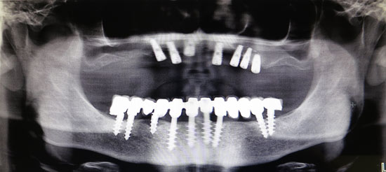 recupero-impianto-dal-seno-mascellare-post.jpg Recupero di un impianto dislocato nel seno mascellare- Radiografia preoperatoria con l'impianto nel seno mascellare destro (freccia bianca) - Radiografia di controllo all'ortopantomografia