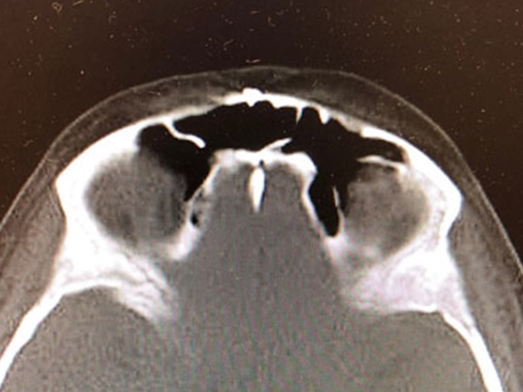 fronte-post.jpg Immagine preoperatoria e post a un anno dall'intervento