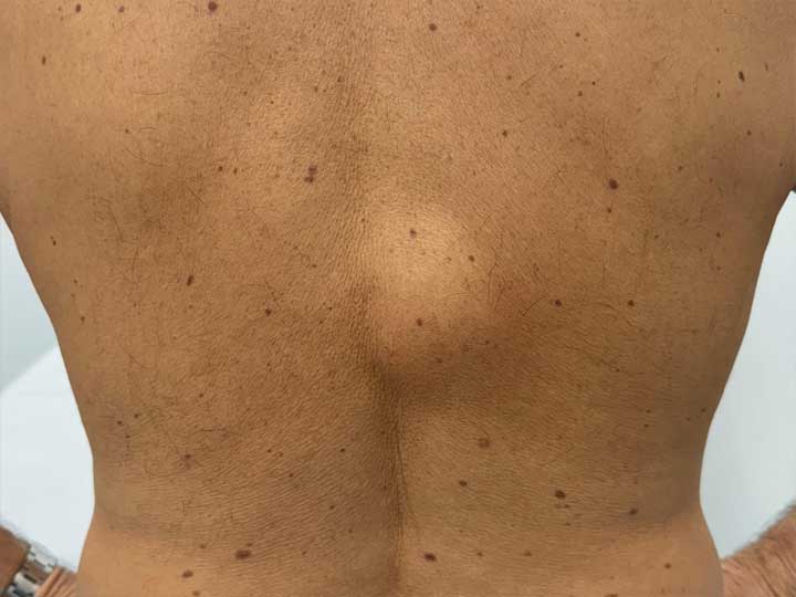 lipoma-dorso-pre.jpg Lipoma dorso pre e post