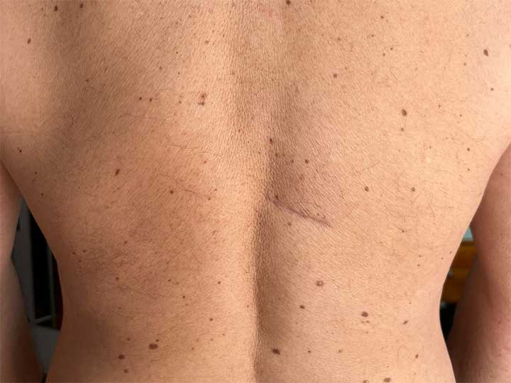lipoma-dorso-post.jpg Lipoma dorso pre e post
