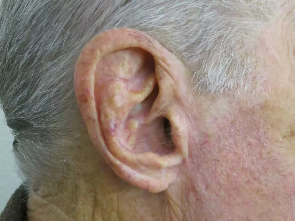 orecchio-post.jpg Basalioma del lobo auricolare destro - immagine pre operatoria e risultato a distanza di 6 mesi