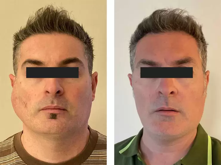 lipoma-parotide-pre-post.jpg 