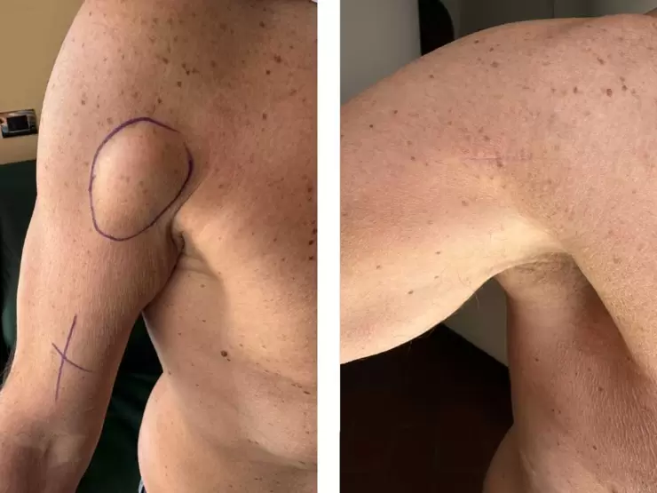  Lipoma spalla pre e postoperatorio